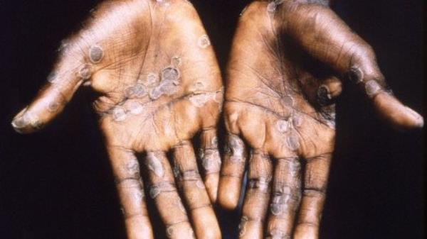 The palms of a mo<em></em>nkeypox case patient from Lodja, a city located within the Katako-Kombe Health Zone, are seen during a health investigation in the Democratic Republic of Co<em></em>ngo in 1997. Brian W.J. Mahy/CDC/Handout via REUTERS
